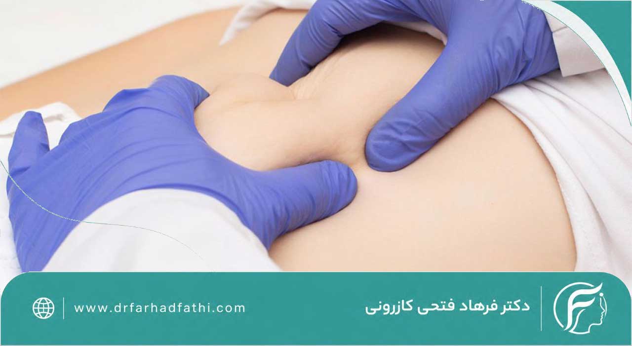 خدمات جراحی فتق