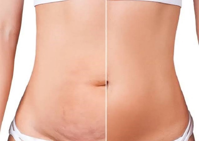 علت ورم بعد از ابدومینوپلاستی چیست؟ چه زمانی شکم کاملاً صاف می‌ شود؟