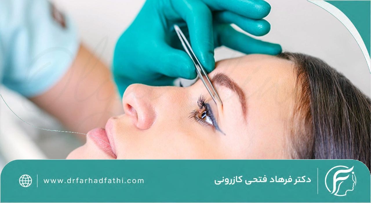 بلفاروپلاستی چیست