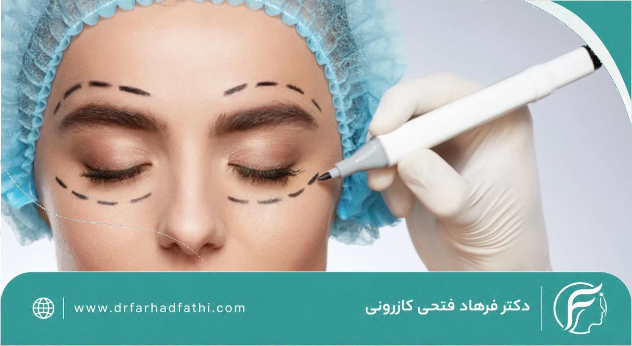 بلفاروپلاستی چیست