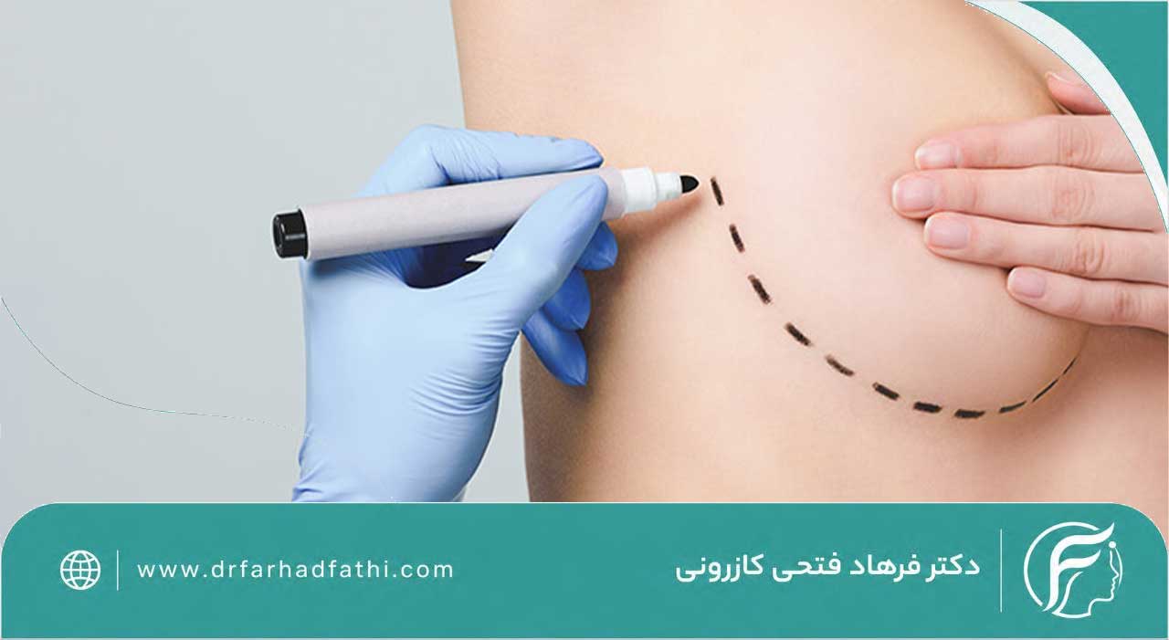 پروتز سینه چیست