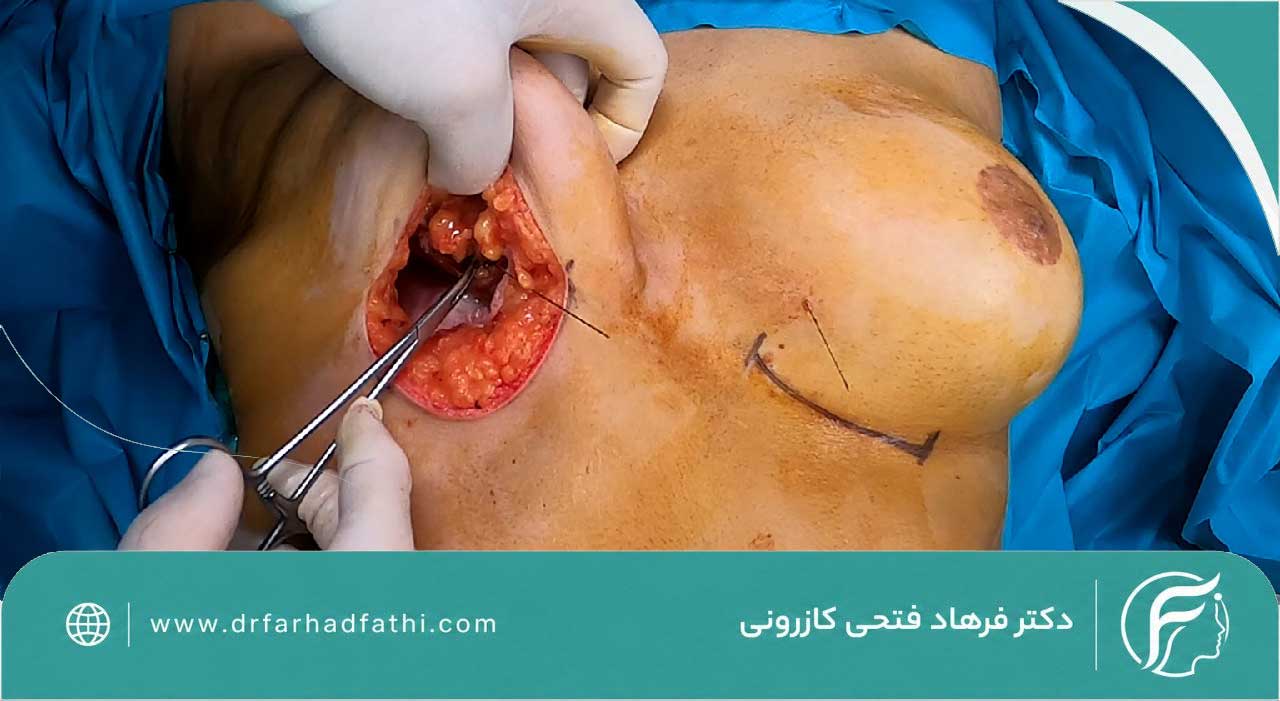 عمل ماموپلاستی