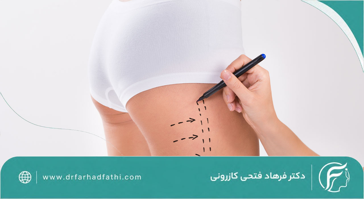 کدام نواحی بدن را می توان با لیپوماتیک فرم داد