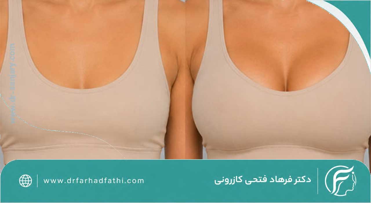پروتز سینه یا تزریق چربی؟