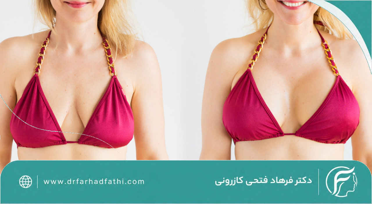 لیفت سینه چیست