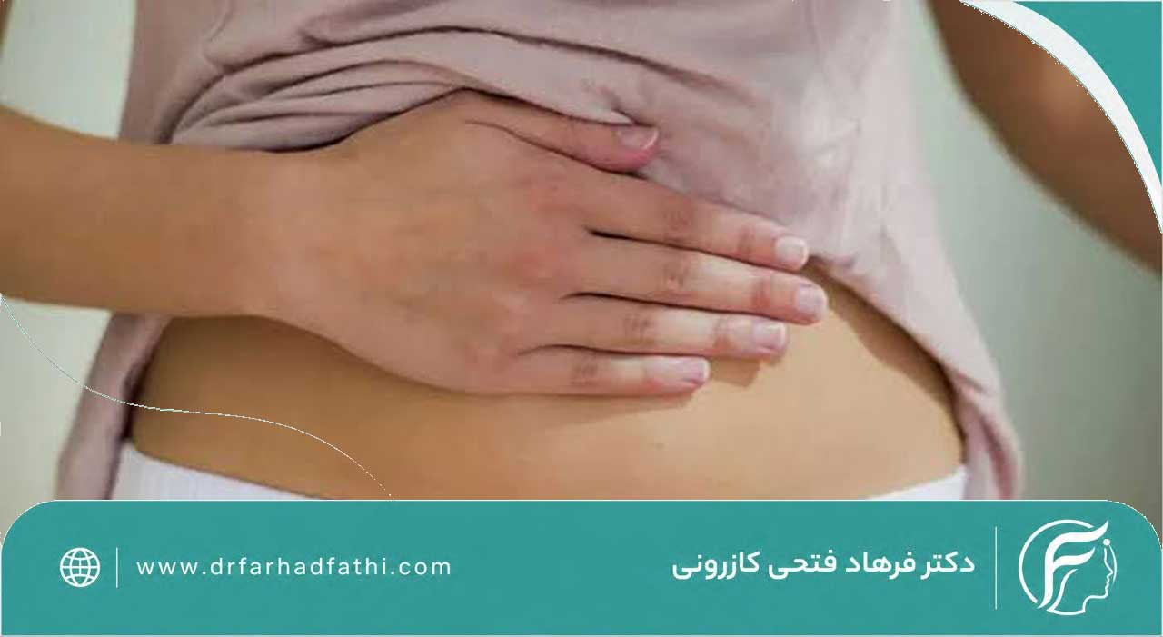 نتیجه ابدومینوپلاستی