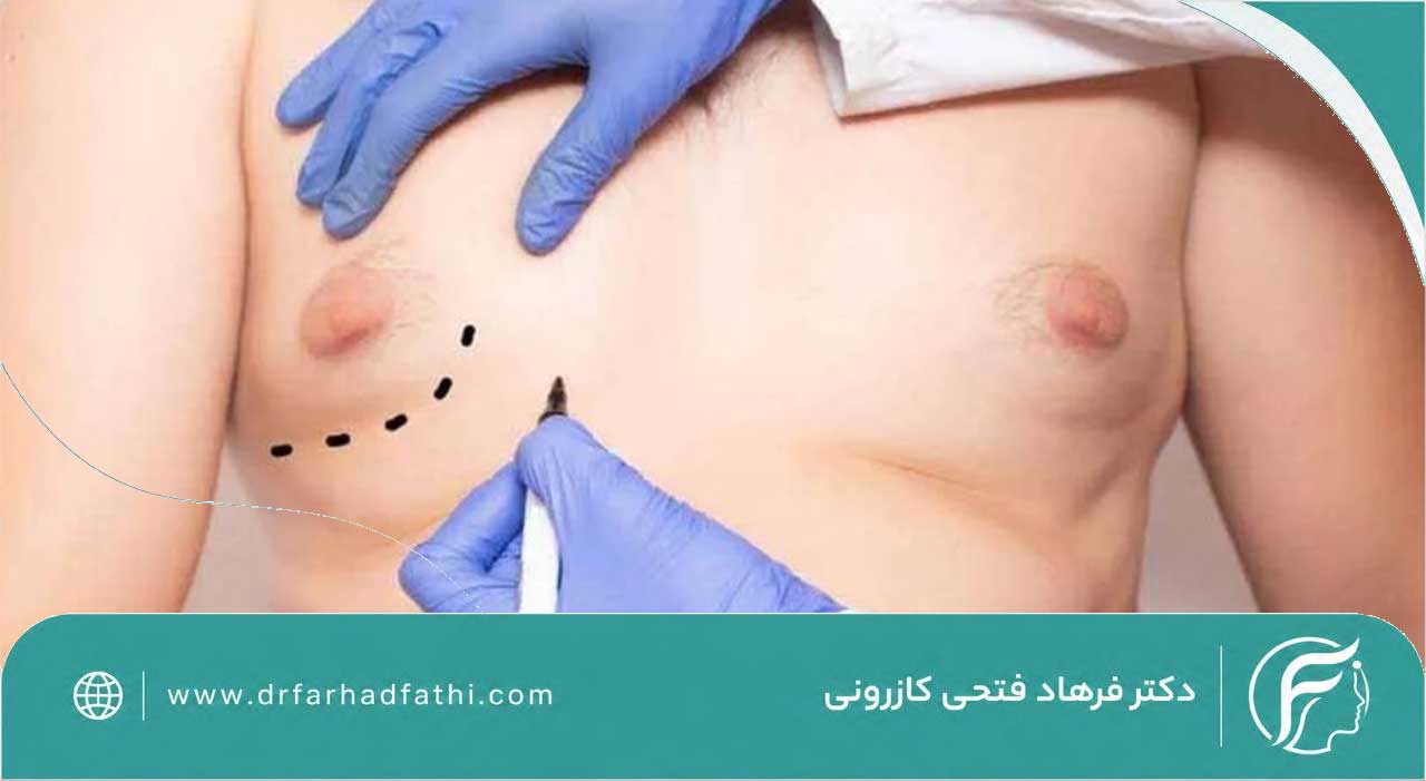 عوارض جراحی ژنیکوماستی