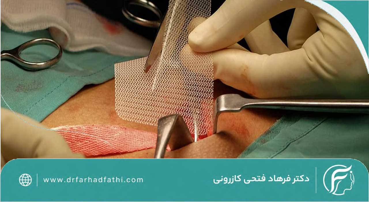روش جراحی فتق