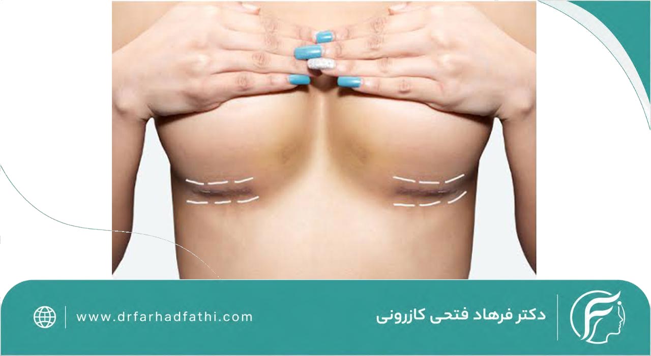نکات مهم برای پروتز سینه