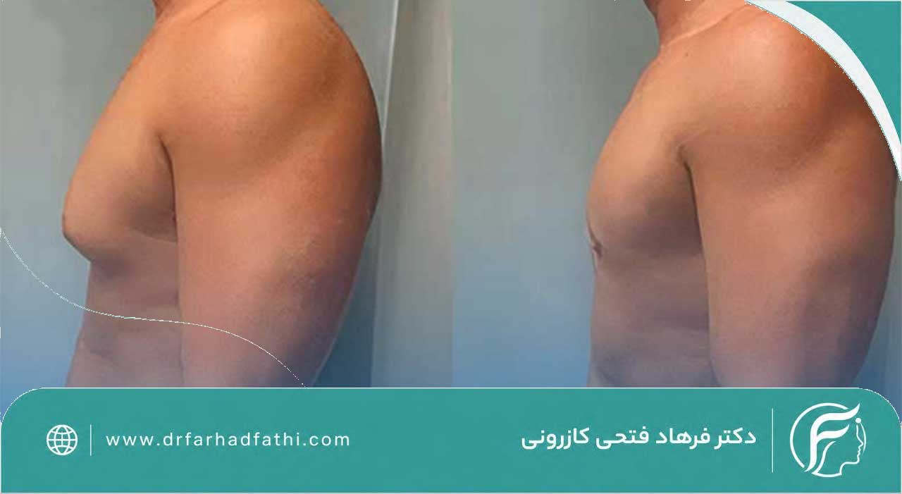 ژنیکوماستی چیست؟