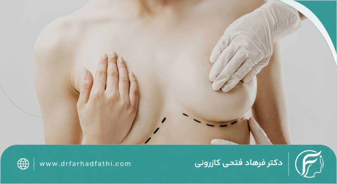 ماموپلاستی چیست