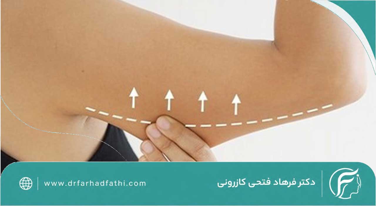 لیفت بازو یا براکیوپلاستی