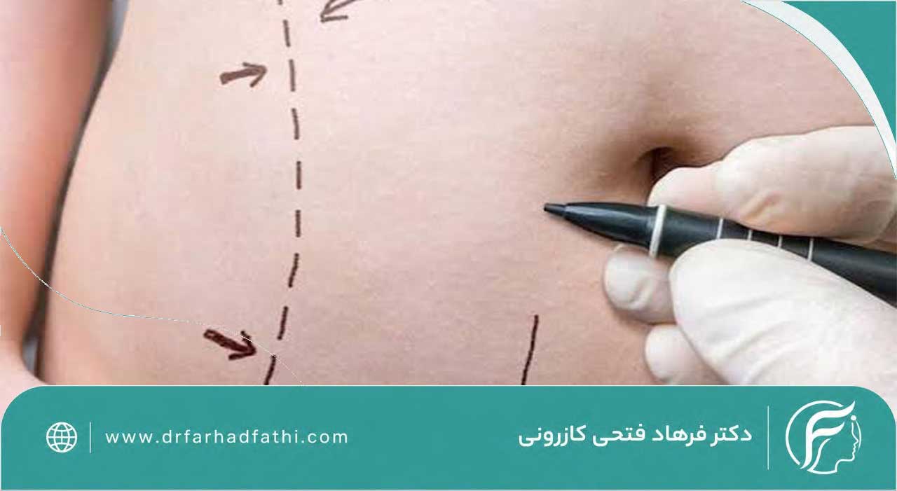 علت ورم بعد از ابدومینوپلاستی