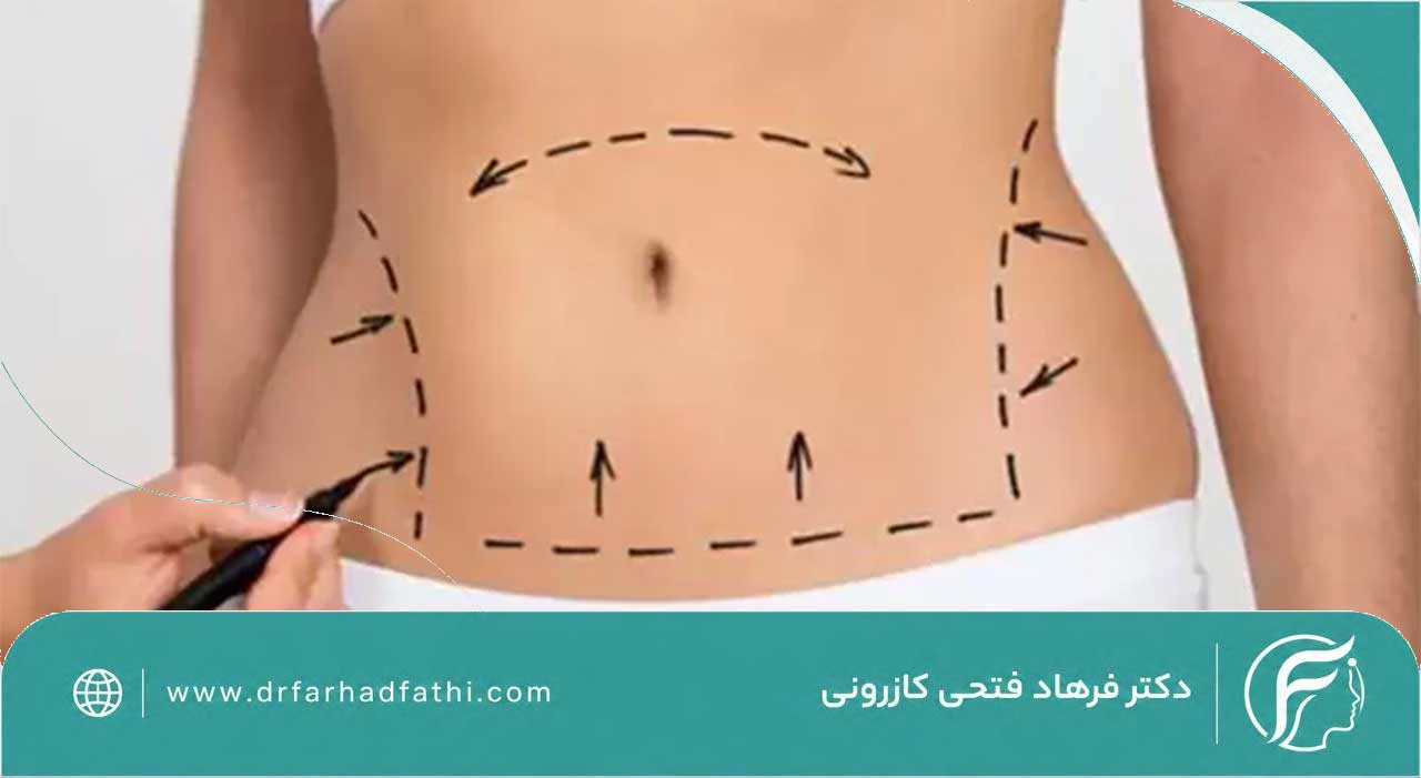 ابدومینوپلاستی چیست؟